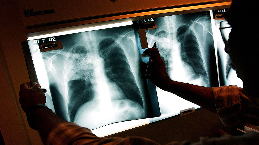 2 active tuberculosis cases traced to San Francisco strip club — KTVU FOX 2 Bay Area, Orinda Health news